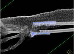 Repair of Radius/ulna Fracture - CTisus CT Scan