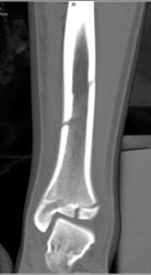 Tibial Fracture Through Epiphyses - CTisus CT Scan