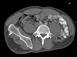 Multiple Heriditary Exostosis - CTisus CT Scan