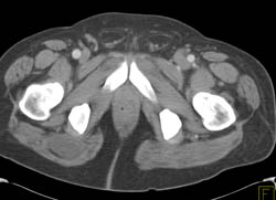 Incidental Soft Tissue Mass in Gluteal Muscle - CTisus CT Scan