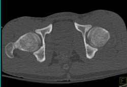 Dislocated Hip and Reduced Dislocation- See Sequence - CTisus CT Scan