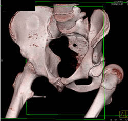 Dislocation of Hip in 3D With Disarticulation - CTisus CT Scan