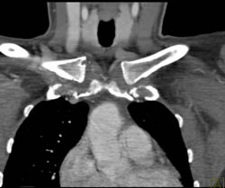 Erosion Right S/c Joint - CTisus CT Scan