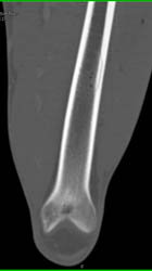 Subtle Femur Fracture - CTisus CT Scan