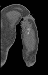 Bleed in Muscle S/P Stab Wound - CTisus CT Scan