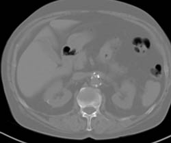 Collapse of L-1 - CTisus CT Scan