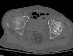 Avascular Necrosis (AVN) Hip- Left - CTisus CT Scan