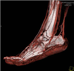 Normal Vascular Anatomy of the Foot - CTisus CT Scan