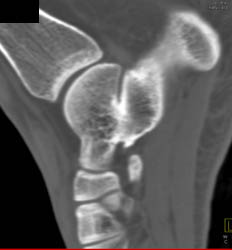 Coalition of Talus and Calcaneus - CTisus CT Scan