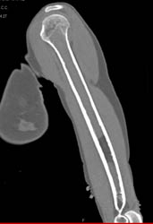 Hematoma in Marrow - CTisus CT Scan