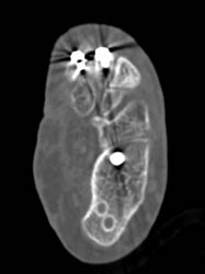 Fusion of Ankle Joint - CTisus CT Scan