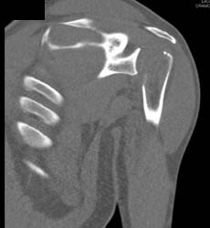 Metastases to Humerus With Fracture - CTisus CT Scan