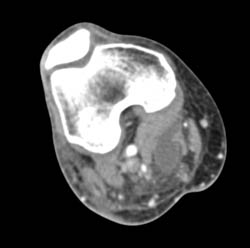 Bakers Cyst - CTisus CT Scan