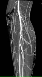 CTA With Bone Edit at Knee - CTisus CT Scan