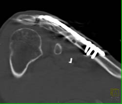 Repair of Nonunion of Clavicle - CTisus CT Scan