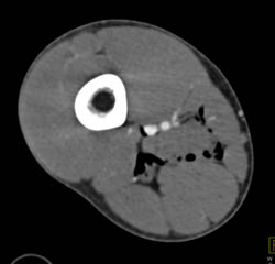 Stab Wound Thigh With Air in Muscle Planes and Injury to Popliteal Artery- See CTA Sequence - CTisus CT Scan