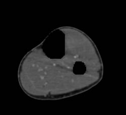 Bone Editing for CTA - CTisus CT Scan