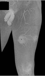 Stab Wound With Hematoma - CTisus CT Scan