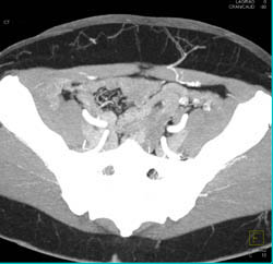 DIEP Planning Study - CTisus CT Scan