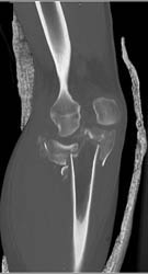 Tibial Plateau Fracture - CTisus CT Scan