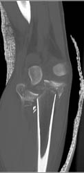 Tibial Plateau Fracture - CTisus CT Scan