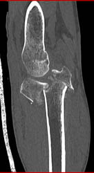 Tibial Plateau Fracture - CTisus CT Scan