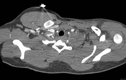 Stent in Axillary Artery Following Injury - CTisus CT Scan