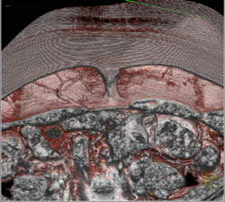 DIEP Flap Planning - CTisus CT Scan