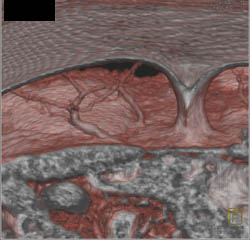 DIEP Flap Planning - CTisus CT Scan