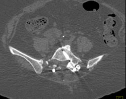 Bony Fusion With 3D Display in Multiple Renderings - CTisus CT Scan