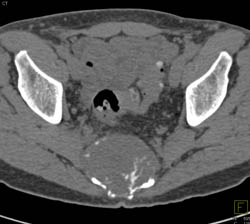 Chordoma - CTisus CT Scan