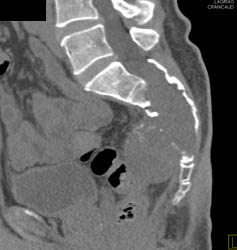 Chordoma - CTisus CT Scan