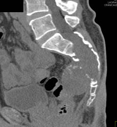 Chordoma - CTisus CT Scan