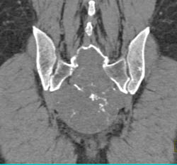 Chordoma - CTisus CT Scan