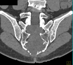 Chordoma - CTisus CT Scan