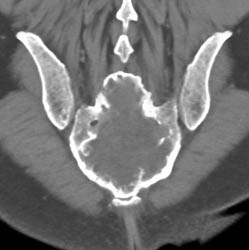 Chordoma - CTisus CT Scan