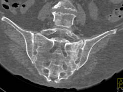 Stress Fracture Sacrum - CTisus CT Scan