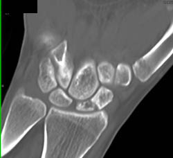 Scaphoid Fracture - CTisus CT Scan