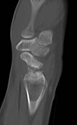 Scaphoid Fracture - CTisus CT Scan