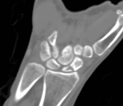 Scaphoid Fracture - CTisus CT Scan