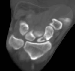 Scaphoid Fracture - CTisus CT Scan