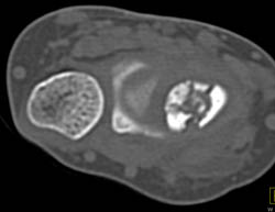 Scaphoid Fracture - CTisus CT Scan