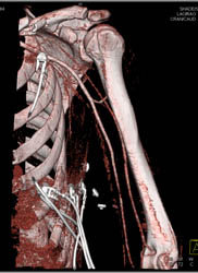 Trauma With Axillary Artery Not Injured - CTisus CT Scan