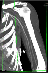 Pins in Acetabulum Near External Iliac Artery - CTisus CT Scan