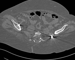 Failure of Spinal Hardware - CTisus CT Scan