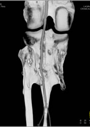 Multiple Hereditary Extosis for Surgical Planning - CTisus CT Scan