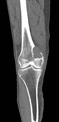 Metastatic Renal Cell Carcinoma - CTisus CT Scan