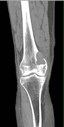 Metastatic Renal Cell Carcinoma - CTisus CT Scan