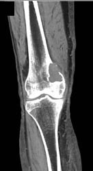 Metastatic Renal Cell Carcinoma - CTisus CT Scan