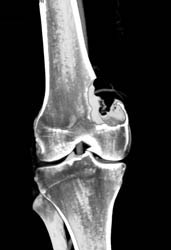 Metastatic Renal Cell Carcinoma - CTisus CT Scan